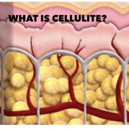 Cellulite: What is the Story?