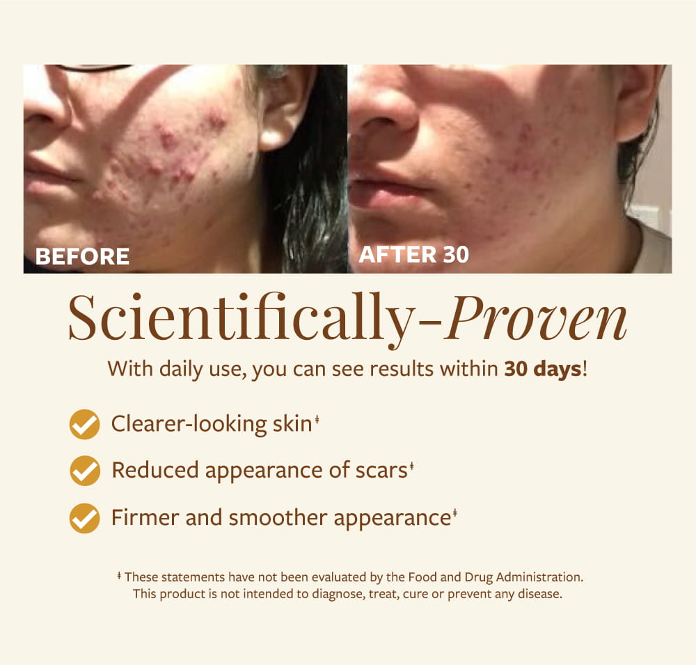 Women before and after photos with focus on acne scars